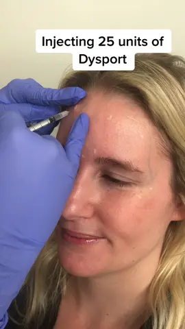 Injecting 25 units of dysport into our other EB nurse!! 🤍💉 #botoxtreatments #treatments #botox #dysport #botoxinjections #dysportinjections #antiwrinkle #antiwrinkletreatment #aging 