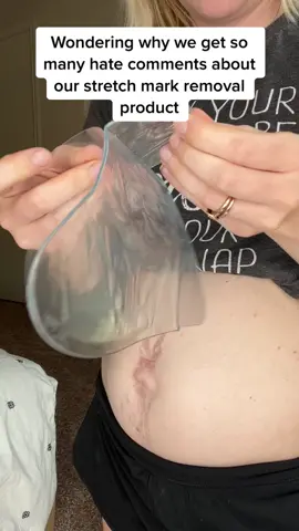 Clinically proven to treat stretch marks ⚠️ #stretchmarks #stretchmarkremoval 