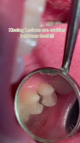 Floss for prevention!!! #kissingbooth #kissing #cavity #caries #teeth #tooth #dentist #dental #dentistry #dds #filling #rootcanal #brush #floss
