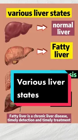 Various #liver states #vsg	 #fyp #foryou #foryoupage #bariatricsurgeon #bariatricsurgery #weightlossmotivation #sleevegastrectomy #sleeve #gastricsleeve #weightloss #loseweight #wls #surgery #fattyliver #cirrhosis #livercancer  #fat #weightlosscommunity #madeyoulook #weightlosssurgery #hualiangweightlosscenter