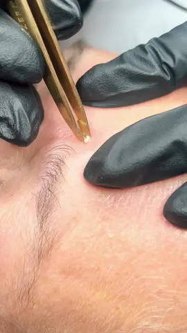 Sebaceous hyperplasia removal using advanced electrolysis, these are little oil pockets and are really satisfying to remove they can look similar to Basal cell carcinoma which tend to have a rough centre. If you have any new changing or unusual blemishes you should always get them checked by your Gp to be sure it’s nothing to worry about. #hyperplasia #sebum #sebaceouscyst #oilcyst #blockedpore #blackhead #pimplepop #pinplepopper #pimplepopper2022 #spot #aging #dryskin #kettering #northampton #clearskin #skincare #skinspecialist #uk#bossit