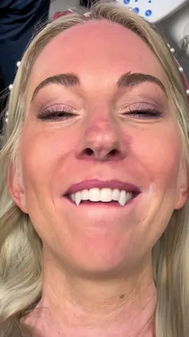 Many of you have been asking about the process for vampire fangs! #howto #fyp #dentist #viral 