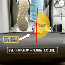 Plantar Fasciitis is often caused by over pronation.  Orthotic insoles can help to control over pronation #ergonx #orthoticinsoles #australia #docpods