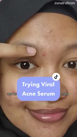 IM IMPRESSED?! the acne has been there for about a week and literally doesnt change but pakai ni for a day terus masak??? #treatyourskinright #healez #beautyguru #TikTokGuru #beautyhacks #beautyhacks #beautytips #akuswipechallenge 