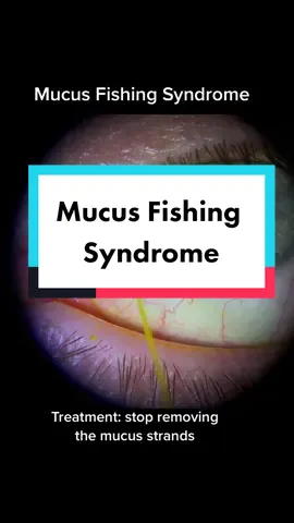 Mucus Fishing Syndrome #mucusfishingsyndrome #eyemucus #eyedoctor #allergy #