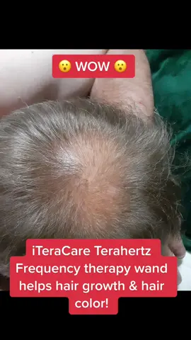 Wow iTeraCare Terahertz Frequency therapy wand helps with hair growth and hair color! 