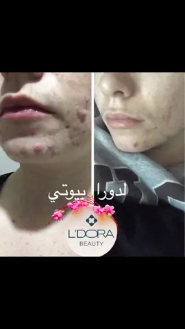 #العنايه_بالشعر_والبشرة #ترند #ترند_تيك_توك #ترند_جديد #ترند_العراق #لدورا #caviar #كافيار #تسريح #اعشاب_طبيعيه #ليدورا_العنايه_بالشعر_والبشرة #قناع_سبايرولينا #البشرة_الحساسة #البشره_الدهنيه #البشرة #البشرة_المختلطه #خالية_من_المواد_الكيمائية #قبل_وبعد #قبل #قبل_و_بعد #ق #حب_شباب 