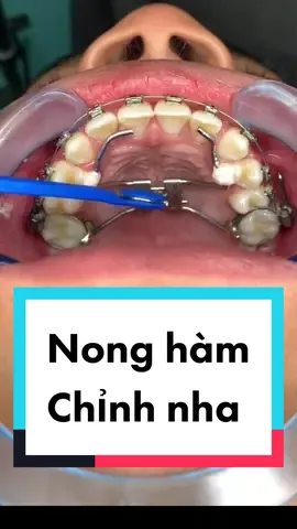 Nong hàm là một kỹ thuật được sử dụng trong quá trình chỉnh nha, sử dụng loại dụng cụ chuyên biệt để nới rộng cung hàm nhằm tăng diện tích vòm miệng. Đồng thời, nong hàm sẽ giúp tạo khoảng trống để các răng của hàm đó dịch chuyển dễ dàng hơn trong khi chỉnh nha. #nongham #khicunhakhoa #nhakhoa #chinhnha #niengrang #niengrangmaccai #chamsocrangmieng 