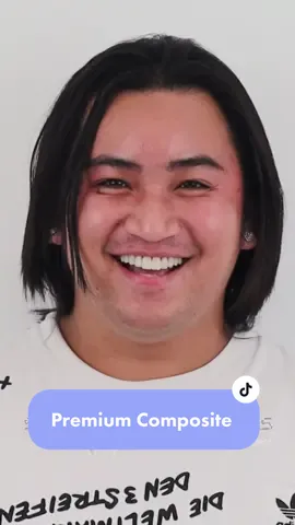 Installation of 10 units natural white Premium composite veneers with minimal. For inquiries, message us in IG: dr.xtianmoscoso and FB: Smile Professionals Premier by: Dr. Christian Q. Moscoso #foryoupage #fyp #foryou #xyzbca #philippines #tiktok #tiktokph #viral #trending #fypage #veneers #dentist 