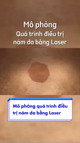Mô phỏng quá trình điều trị nám da bằng Laser. Thẩm mỹ viện Adona #tmvadona #reviewlamdep #xuhuong #viral 