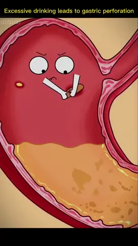 #excessive #drinking #cause #gastric #perforation #foryou #fypシ