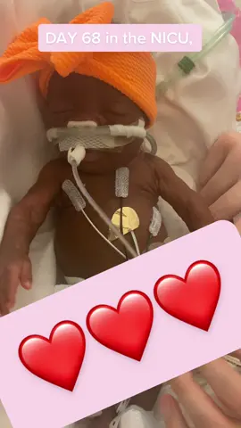Day 68 in the nicu , Miyanna was taking off the cpap machine and placed on nasal cannula which was a big step. 2 pounds 5 ounces. Her liver is doing way better, MRI and lab work has showed improvement with the liver. #fyp #fypシ #foryou #foryoupage #miyannajourney #nicu #nicunurse #nicujourney #niculife #nicustrong #nicustrong💜 #preemie #preemiestrong #preemiemom #preemiemommy #preemiebaby #micropreemie #micropreemiestrong #micropreemies #micropreemiereborn #preemie #preemiestrong #preemiebaby #preemiemommy #preemiewarrior #preemiepower #preemies 