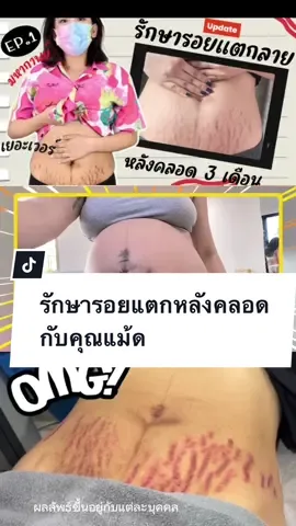 รีวิวจากผู้ใช้จริง ขอบคุณคุณแม้ด เพจ CU.FITGIRL มากๆนะคะ สำหรับการรีวิวเซ็ต ครบจบหาย เพื่อรักษารอยแตกลายหลังคลอด 😚🧡 #bebetterthailand #ครีมน้ําตบสยบรอยแตก #เจลหอมแดงสมานผิว #รีวิวบิวตี้ #ที่สุดแห่งปี 