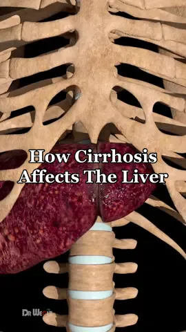 How Does Cirrhosis Affect The Liver #animation #liver #cirrhosis #health 