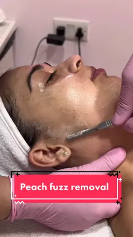 Peach fuzz removal😍 #dermaplaning #dermaplane #hairremoval #london #londonbeauty #fyp #foryou #fy #smoothskin #babyskin #facialtreatment #skin 