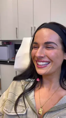 safe to say im in love with the results #newlips #lipfiller #naturallipfiller #lips #beforeandafter  
