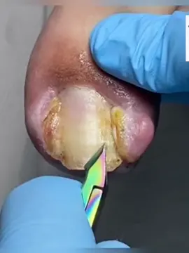 #ingrowntoenail #pedicure #foot #nails #satisfying #foryou 