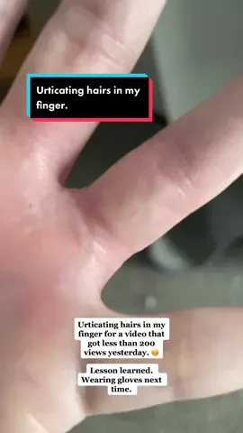 #urticatinghairs #tarantula #tarantulatoktik #AmazonSavingSpree #imdumb #mistakesweremade #itchy #pets#arachnidkeeper #arachnidsoftheworld #nhanduchromatus #brazilianredandwhitetarantula #fypシ #theparadoxspot 