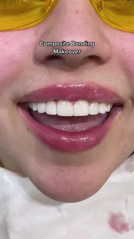 Dr Richard using composite bonding on 8 upper teeth to close the middle gap & reshape the smile ✨🤍
