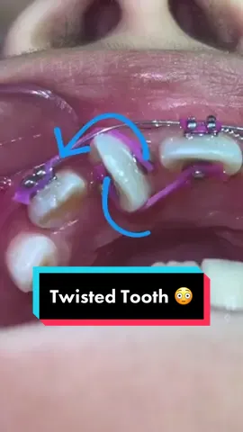 Crazy twisted front tooth vs braces 😳 #braces #stitch with @Dr. Diler Cruz 