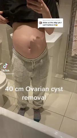 Replying to @Kurai chan Before and After 40 cm cyst removal #FYP #surgery #ovaries #PCOS #BellaHadid #StThomas #Hospital 