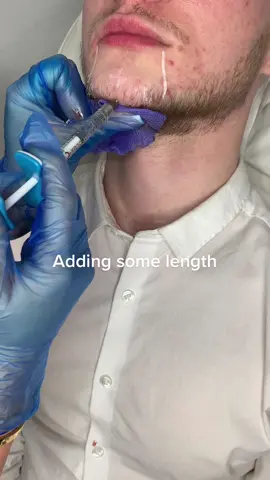 #chinfiller #juvederm #juvedermvolux 