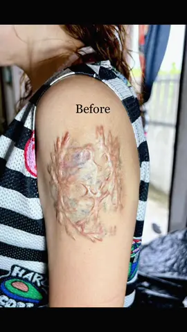 #งานแก้รอยสัก #coveruptattoo #pitbull#pitbulltattoo#scar#coverupscartattoo #รอยแผลเป็น#คีรอยด์ #เลเซอร์รอยสัก#ช่างสักผู้หญิง #หัวหิน #girltattooartist #tattoo #รอยสัก 