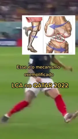 Como ocorre a lesão do LCA em jogadores de futebol ⤵️  1️⃣ 88% dessas lesões ocorrem sem contato no joelho e 44% sem nem contato entre atletas;    2️⃣ 51,5% das lesões ocorrem durante situação de marcação pelo atleta;    3️⃣ O mecanismo mais comum nas lesões do LCA em jogadores de futebol é:  - inclinação do tronco homolateral a perna lesionada;  - abdução + rotação interna do quadril;  - abdução da tíbia (valgo dinâmico de joelho;  - pé fixo no chão com hiperpronação. #lesões #copadomundo #qatar2022 #futebol #france #hexa #fisio #lca @dr.augustorafael 