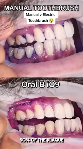 AD Is an excellent manual brusher 🪥 just as good as an electric brusher⚡️? . I put this theory to the test🔬and HAVE A LOOK at the results! . I kid you not, I put my heart 💙 and soul in to the manual brushing... The fact of the matter is: Manual brushes only remove 50% of the plaque. . By switching to an Oral B Electric Toothbrush you can get that 'Dentist clean' feeling ✅ . Some cracking deals for Black Friday on the way - let's get rid of that disease-laden plaque! . Link: https://shop.oralb.co.uk/for-adults.list
