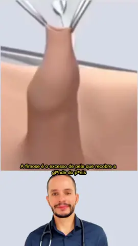 Fimose é a dificuldade ou impossibilidade de expor a gl*nde (a cabeça do p*nis) porque o estreitamento do prepúcio (prega de pele que envolve a gl*nde) impede a passagem. Nos primeiros meses de vida, existe uma aderência natural do prepúcio à gl*nde. Porém, até os 5 anos, essa aderência desaparece na maioria dos meninos. As principais causas da fimose são assaduras e cicatrizes que retraem a pele, deixando o anel do prepúcio mais estreito. Falta de higiene adequada também pode ser responsável pela incidência de inflamações ou infecções que estreitam a abertura do prepúcio. Higiene local é a melhor maneira de prevenir a fimose e evitar as balanopostites (infecção ou inflamação do prepúcio). Exercícios ou massagens para arregaçar o prepúcio devem ser evitados, pois além de causar dor, podem provocar sangramentos e, como consequência, a formação de cicatrizes que reduzem ainda mais o orifício por onde a glande deve passar. Em geral, é normal ter algum grau de fimose até os 5 anos de idade. A retração pode acontecer naturalmente muitos anos depois, até na adolescência, mas a partir dos 5 anos recomenda-se ficar de olho junto com o pediatra para decidir sobre o início de algum tratamento.   A cirurgia de fimose é oferecida pelo SUS? Sim, o Sistema Único de Saúde realiza a cirurgia gratuitamente segundo indicação médica.