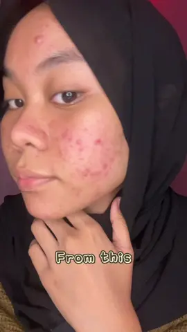 Alhamdullilah better lah yaaaa #JeratJerawat #YOUAcnePlus #YOUSkincare 