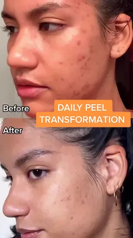 🎥 Our Video Producer, Emily, shares her personal skin story using the Alpha Beta Extra Strength Daily Peel! 🧡 #drdennisgrossskincare #chemicalexfoliation #chemicalexfoliant #acnetreatment #acneskin #skincaretransformation 