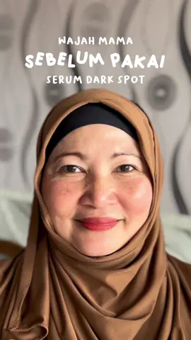 mamaku seneng banget akhirnya #darkspots hilang gara gara pake ini #skintificid #CantikGakAdaBatasan 