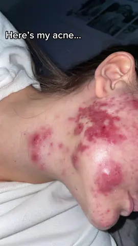 ACNE IS NORMAL! This page is a safe place💗 #acneproneskin #acnepositivity #acne #acnejourney #acneskin #acnefighter #acneisnormal #acneproneskin 