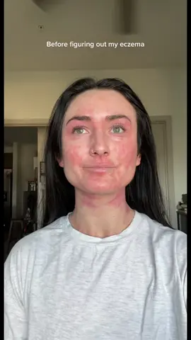 Eczema can be an everyday battle, confidence killer,  anxiety inducer…the list goes on! I tried everything from blue light therapy, IV treatments, and countless diets. I was finally prescribed Dupixent and it changed my life. #eczema #eczemahealing #eczematiktok #dupixent #HealingJourney 