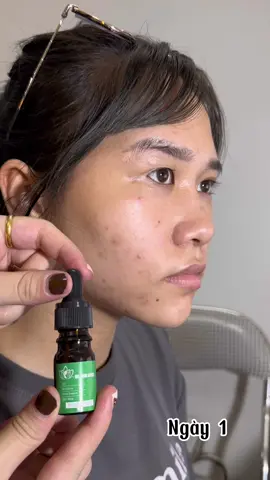 Tạm biệt thâm mụn, mụn đầu đen, lỗ chân lông to, nám, tàn nhang, sẹo rỗ với 3k mỗi ngày.