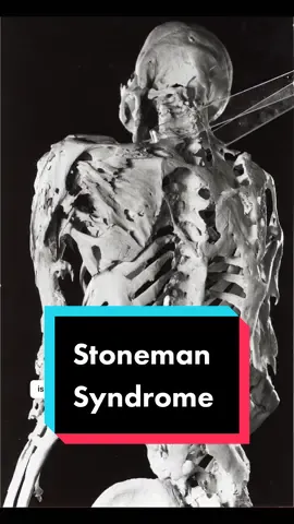Fibrodysplasia Ossificans Progressiva or Stoneman Syndrome is a progressive disorder of the connective tissues of the body.  A gene mutation causes unregulated and maladaptive bone growth. It also causes the conversion of muscle and tendons into bone (ossification).  Honestly, it looks like a curse that you would find in Eldenring.   #medicalmystery #pathology #extracredit #stoneman #eldenring  @