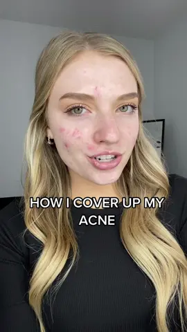 Step by step on how I cover up my acne • #acnecoverage #howicovermyacne #acnetips #makeuptips #makeupartist #makeupacneproneskin 