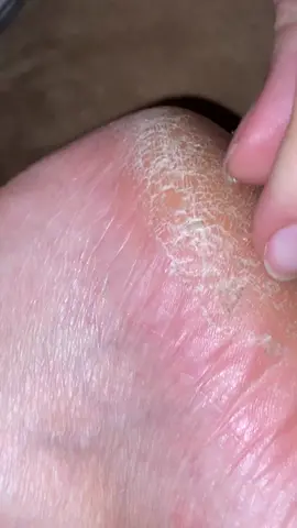 Have you heels ever gotten this rough and dry? #roughfeet 