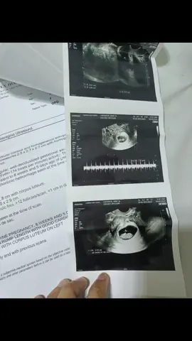 Hi anak 😘 2nd ultrasound natin just to check okay heartbeat mo at ayan na nga mabilis na 🥺 mahal na mahal ka namin ng daddy mo kapit ka lang dyan 😘😍 #firsttimemom #pregnancy #1sttrimester  #pcosbaby #fyp #2monthpregnancy🥰 #teamjuly2023🤰🏽 