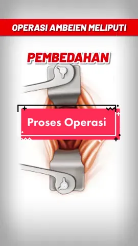 Ini dia proses operasi ambeien #ambeien #wasir #xiyaopinzhi #hemorrhoid 