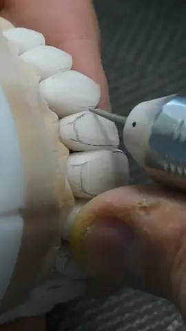 Cận cảnh chế tác răng sứ thẩm mỹ 🥰