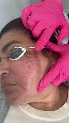 Our #PicoSurePro laser treats #hyperpigmentation and #melasma in the #skin 👩🏻‍⚕️ #skincare #laser #beauty 