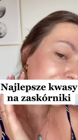 Kwas salicylowy i azelainowy to naszym zdaniem najlepsze połączenie na zaskórniki otwarte, zamknięte oraz trądzik. Kwas salicylowy w stężeniu 2% rozpuszcza nagromadzone w ujściach gruczołów łojowych sebum, bo jest to kwas rozpuszczalny w tłuszczach. Rozluźnia połączenia międzykomórkowe, dzięki czemu umożliwia oczyszczenie tak zwanych porów. Idealnie działa na zaskórniki otwarte, czyli wągry! To działanie ułatwia pracę naszemu drugiemu agentowi, czyli kwasowi azelainowemu w stężeniu 10%. Ten składnik działa świetnie na zaskórniki zamknięte i trądzik, a w połączeniu z kwasem salicylowym jego efekty są znacznie szybsze i lepsze! Oba te kwasy nie są fotouczulające, a nasze serum przeciwtrądzikowe może być stosowane także na cery wrażliwe i suche!