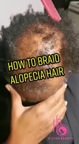 Who said you can't get kinky twist because of alopecia.😘 #viral #alopeciabraidstyles #hairlossbraider #viralvideo #alopeciaawareness #beauty #alopeciabraider #beginnerbraiders #braidstutorial 