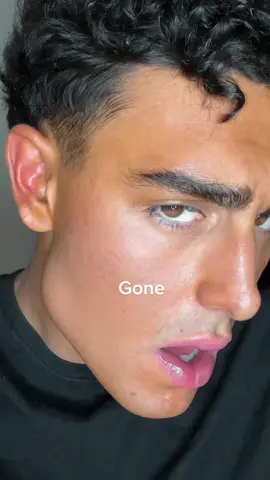 This is how i got rid of my acne scars #fypシ #SelfImprovement #acnescars  #Gabrieldridi 