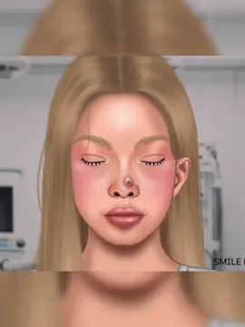 Remove unmanaged piercing pus #pimples #pimplepopper