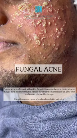 Do you know what is Fungal Acne?   Well, If you have it, don’t hesitate to contact us here at @radiantclinique_rc   Contact Radiant Clinique today to book your appointment!  #radiantclinique #radiant #newest #treatment #medicalaesthetics #kulitcantik #nakcantik #lawa #doktor #bukitjelutong #shahalam #fyp #foryoupage 