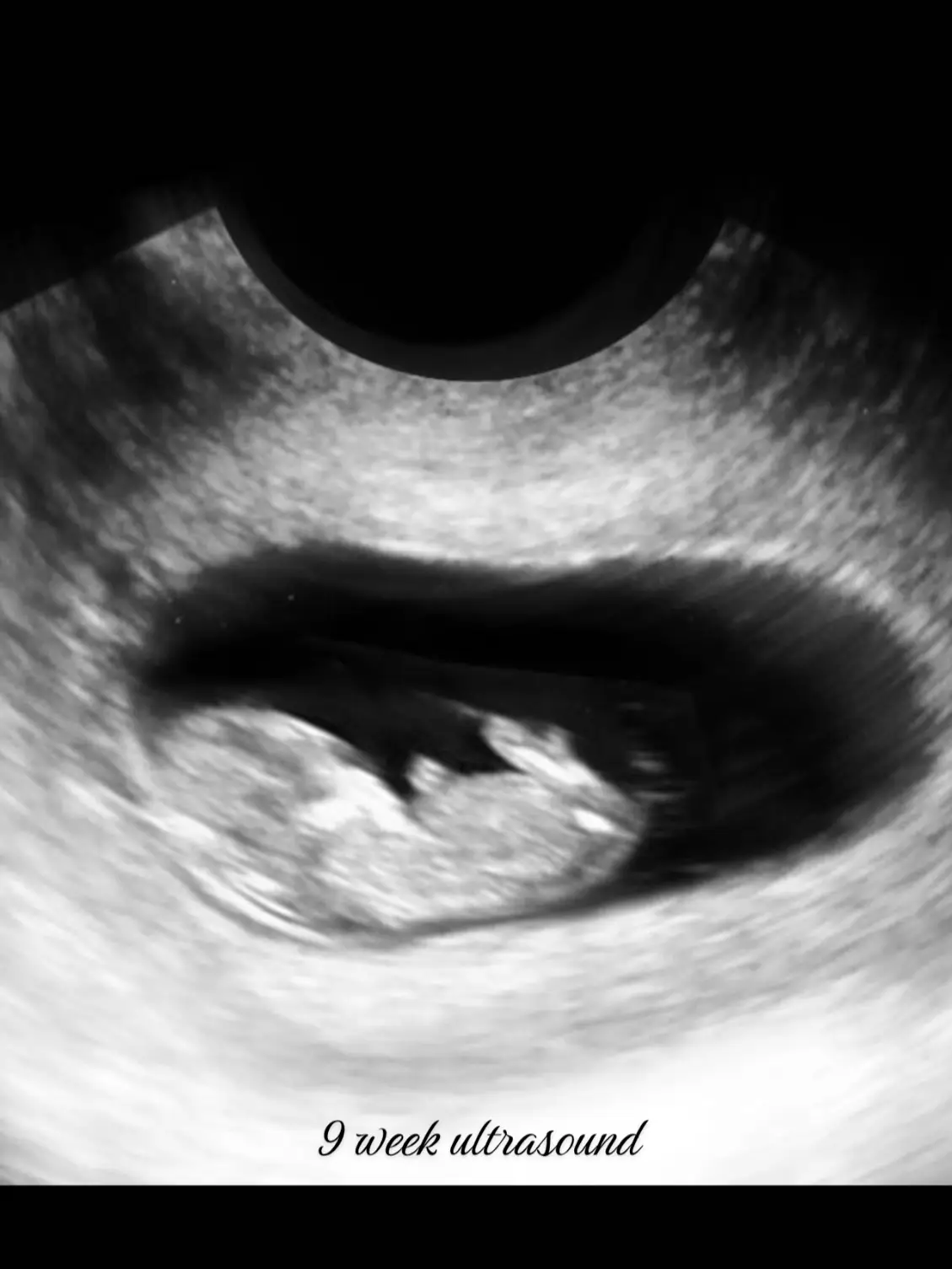 9 week ultrasounds! 🕊👶🏻 #ttcjourney #ttc #ttccommunity #rainbow #rainbowbaby #angelbaby #angelbaby #motherhood #baby #earlypregnancy #9weekspregnant   (Not my pictures for demo purposes only) 