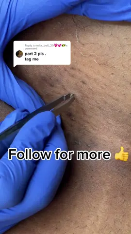 Replying to @tella_bell_20💖💞🇯🇲 book your appointments with me ladies! You won’t be disappointed 👍 #drpimplepopper #drpimplepopping #extractionslovers #extractionsatisfaciton #extractions #pimplepopper #ingrownremoval #ingrownsatisfying #oddlysatisfying #oddlysatisfyingvideo #fypシ #viral 